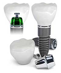 Dental Implants in New Hyde Park