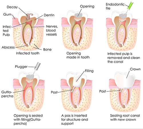 Root Canals in New Hyde Park