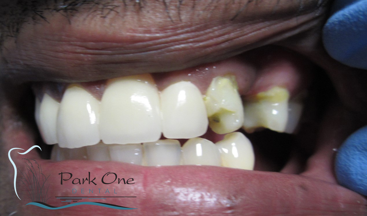 Floral Park Before and After Cosmetic dentistry 