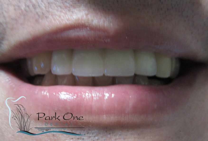 Before and After Cosmetic dentistry  near Garden City