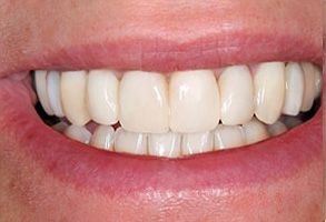 Garden City Before and After Invisalign